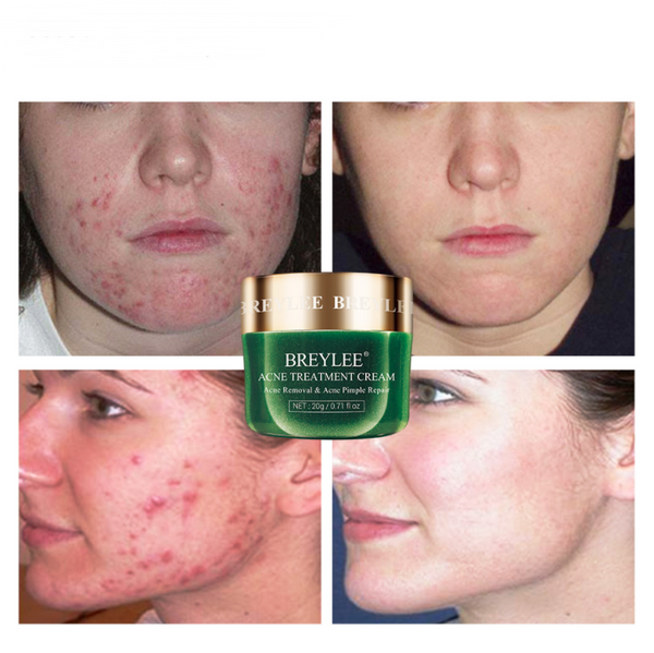 BREYLEE Acne Treatment Cream
